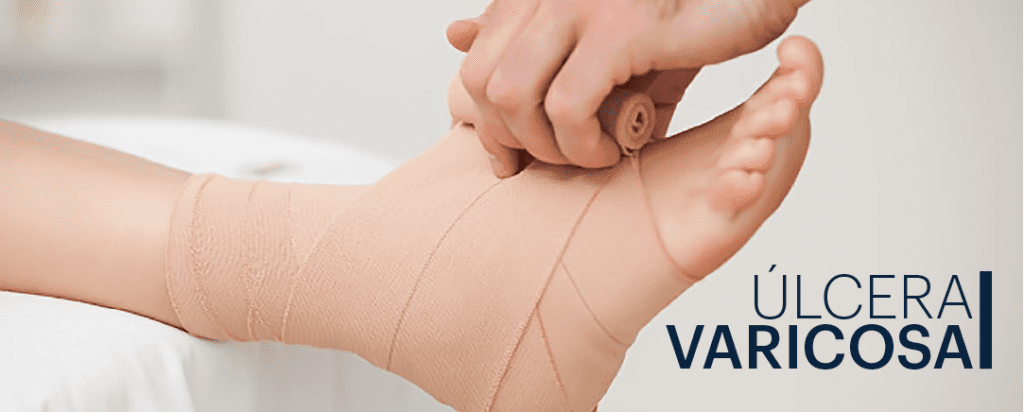úlcera varicora